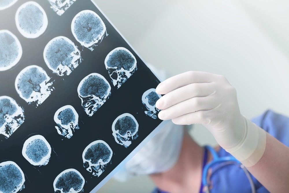 Albuquerque brain injury attorney examining medical imaging related to a head injury